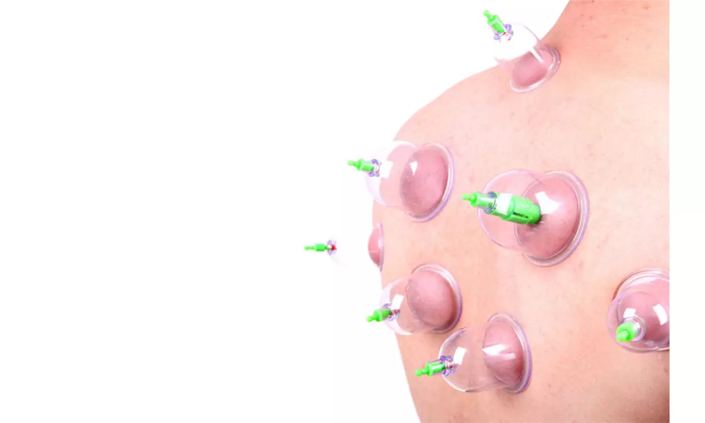 6 x Cupping Therapy Hijama Set for Self-treatment at Home - Second Medium
