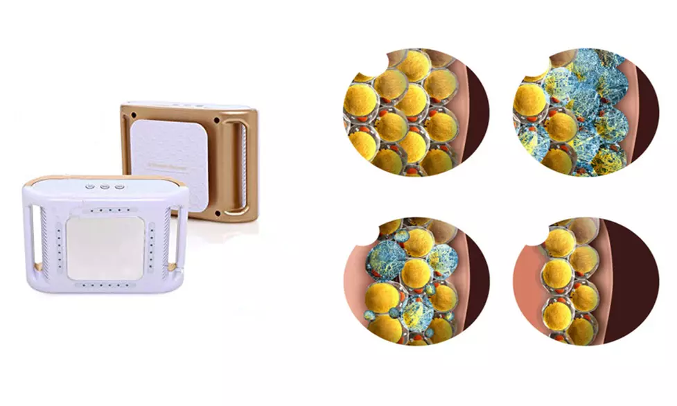 Fat Freezer Platinum Targeted Cold Cryolipolysis System (Standard) - Second Medium