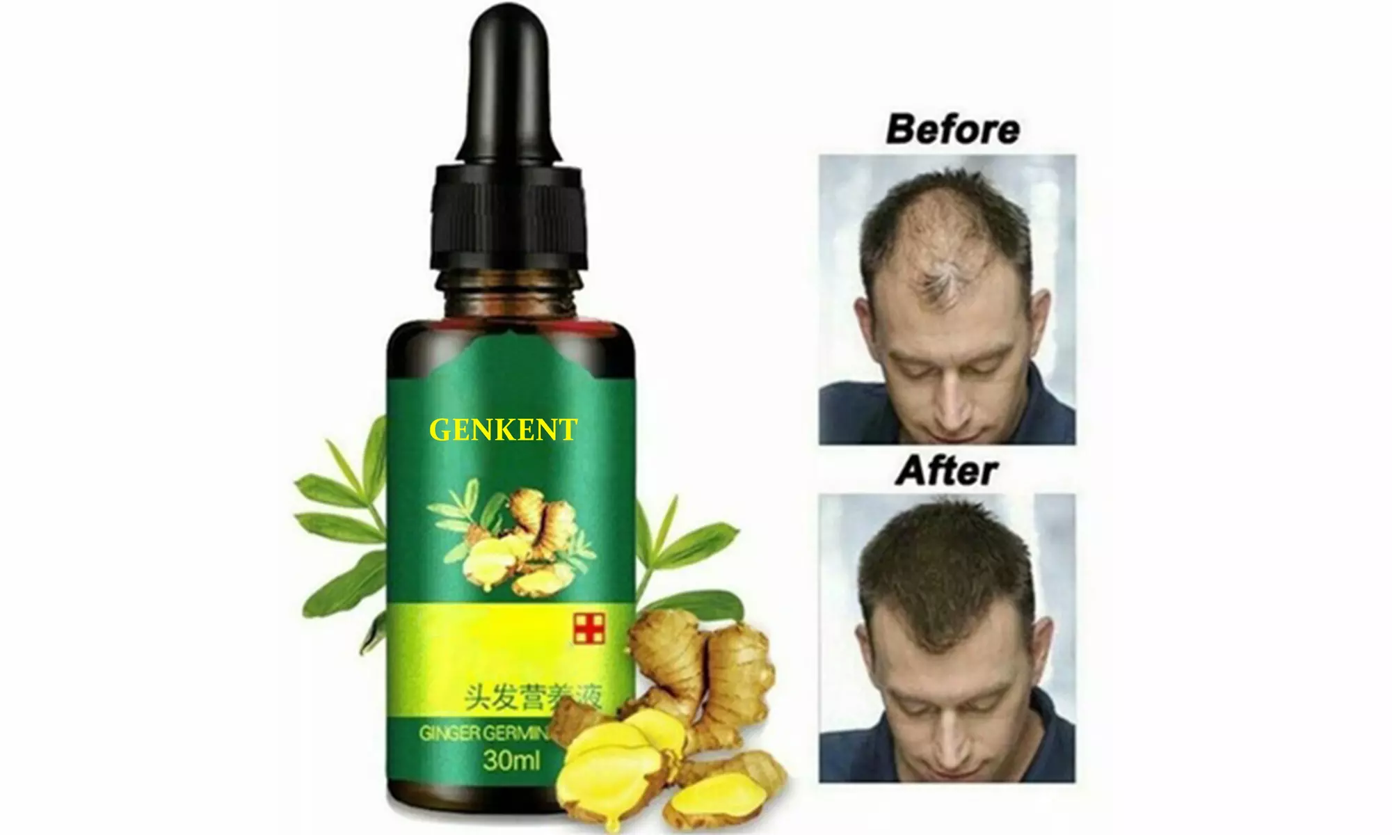 5 Bottle Hair Regrow Serum 7 Day Ginger Germinal Serum Essence Serum 5 x 0.1oz - Second Medium