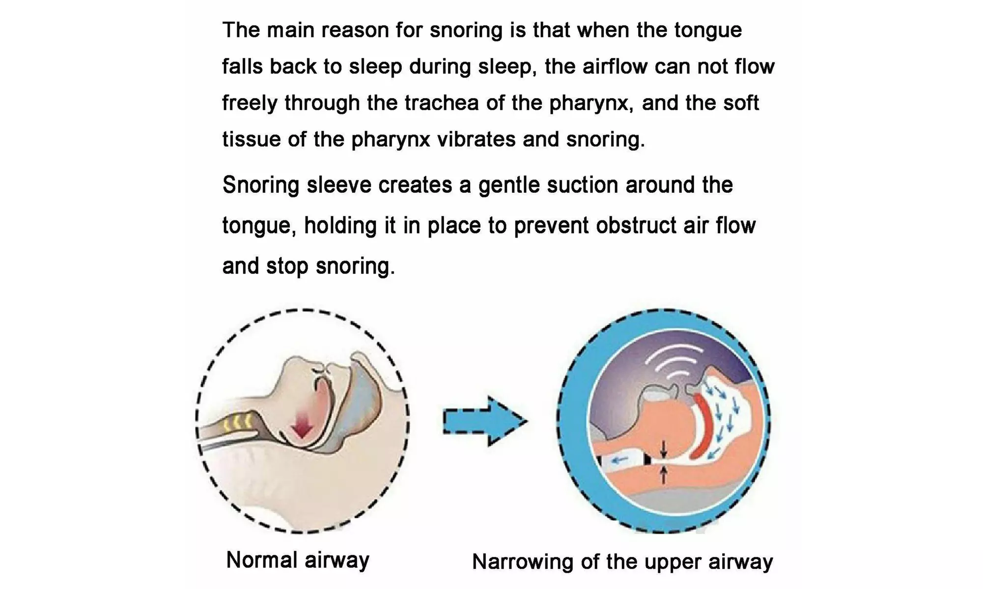 Anti Snoring Tongue Device Sleep Apnea Aid Night Stop Snore Sleeve(1- 2pcs)