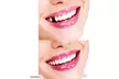 Instant Smile Teeth THERMAL FITTING BEADS Dr Bailey's Dental Makeover Pk-3 - Second Medium