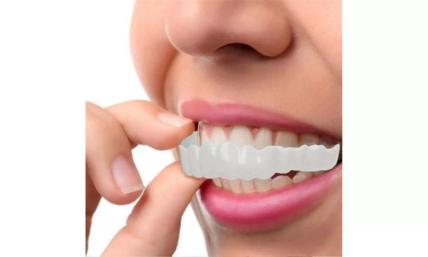 Perfect Smile Snap-On Braces - Second Medium