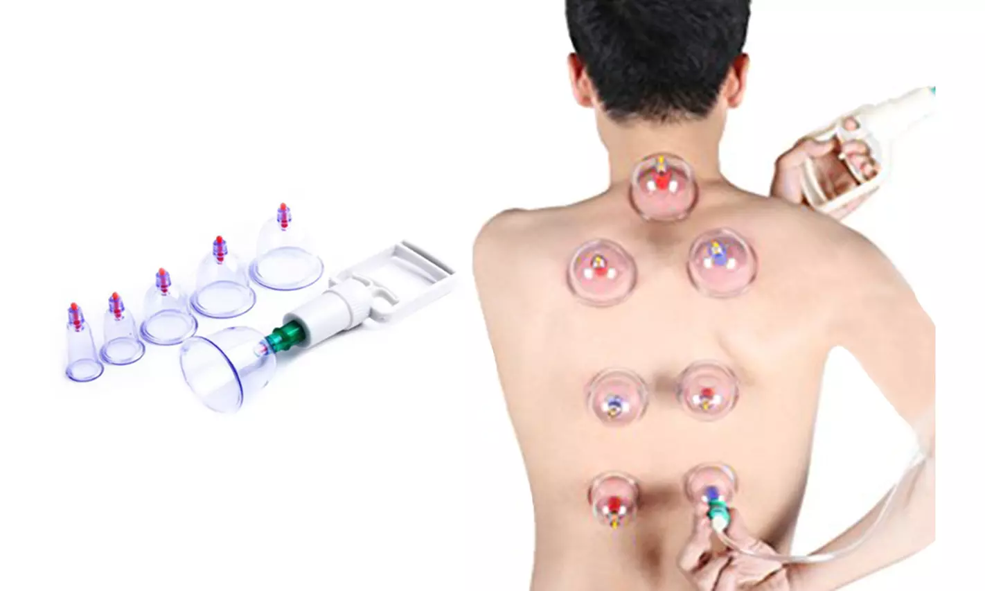 6 x Cupping Therapy Hijama Set for Self-treatment at Home - Primary Image