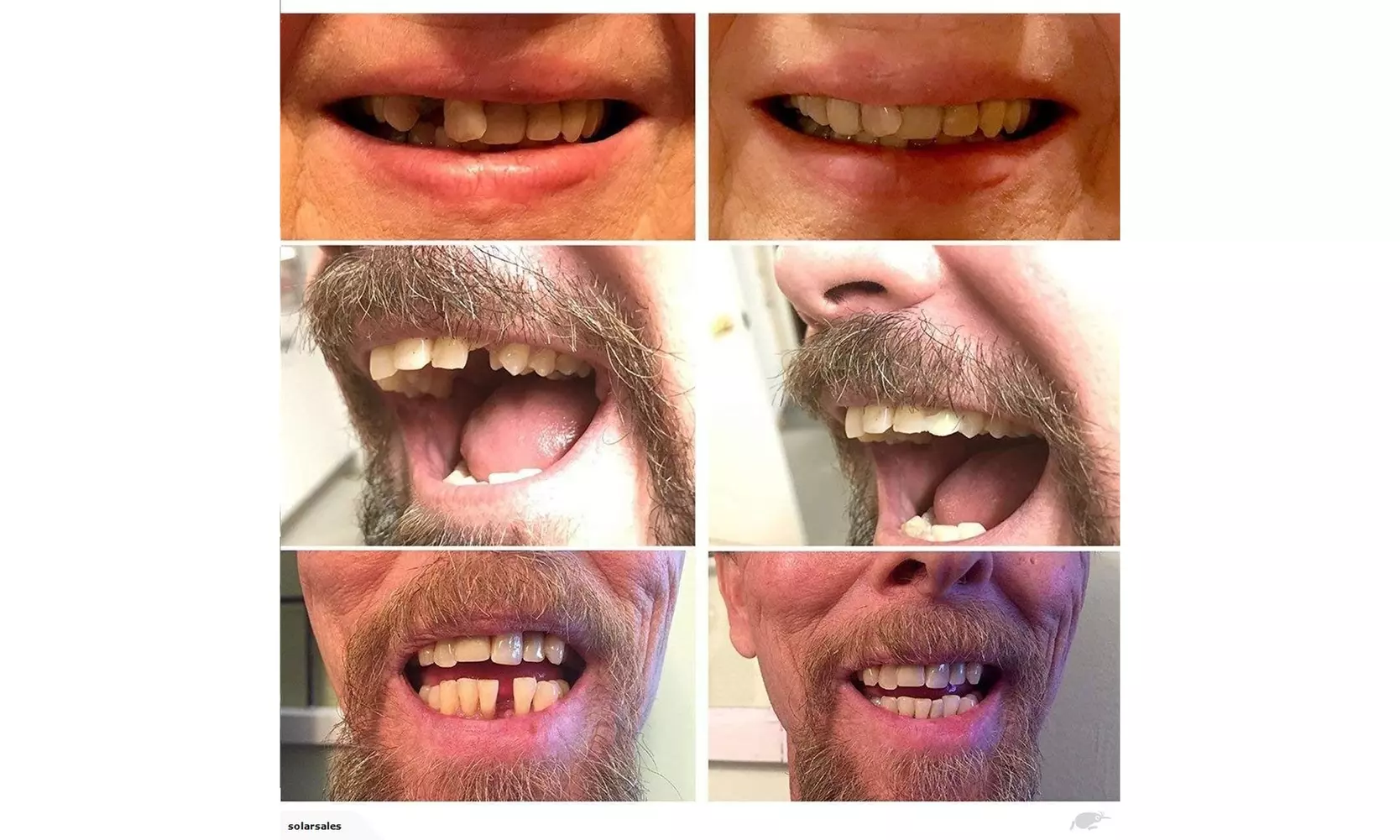 Instant Smile Teeth THERMAL FITTING BEADS Dr Bailey's Dental Makeover Pk-2 - Second Medium