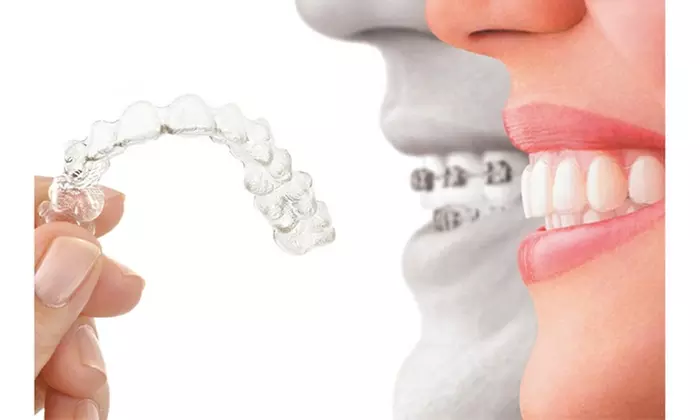 Orthodontic Retainer Teeth Corrector Silicone - Second Medium