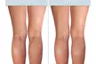 Clearly VEIN, Varicose and Spider Vein Treatment with Horse Chestnut - Second Medium