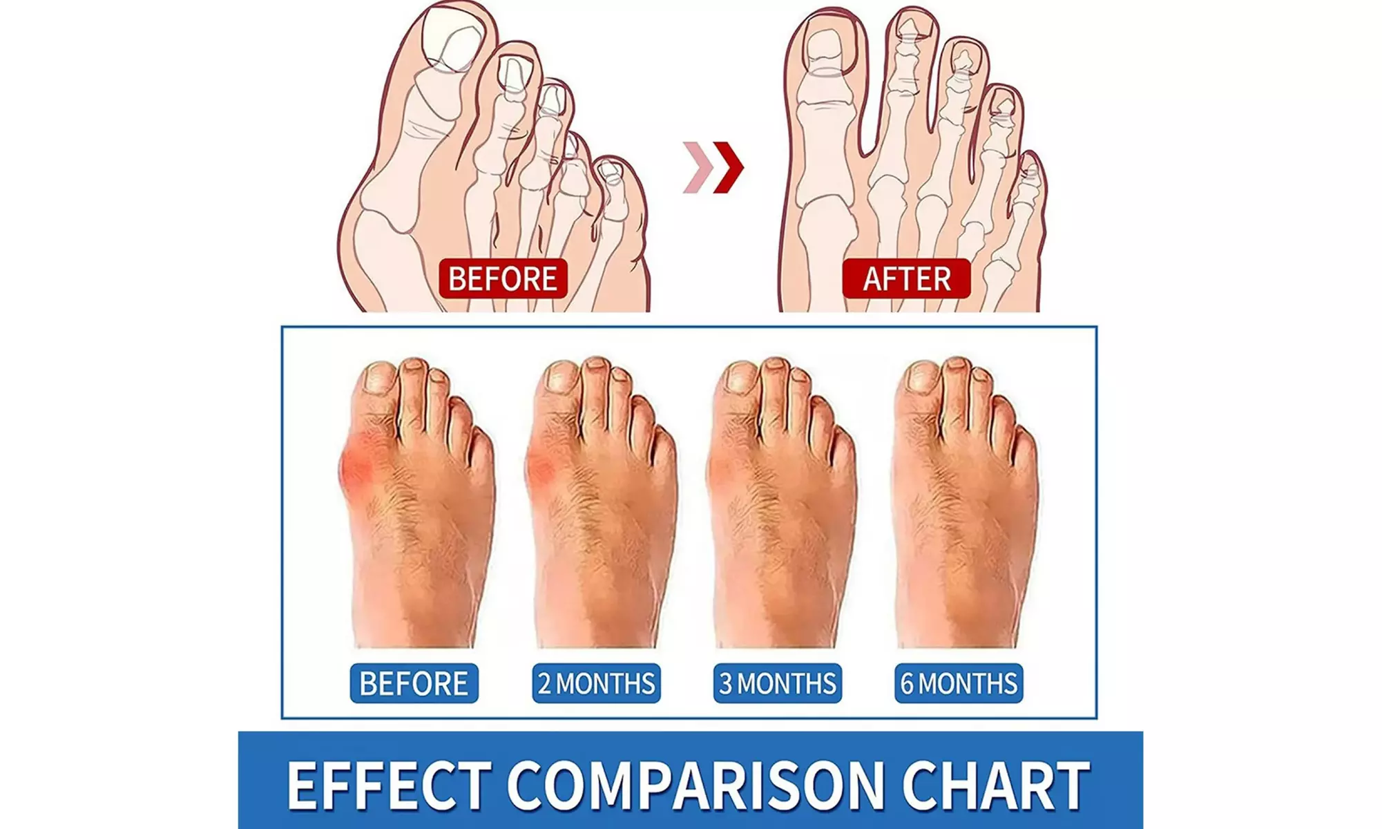 Big Toe  Bunion Corrector Pain Relief Hallux Valgus Corrector Support Brace