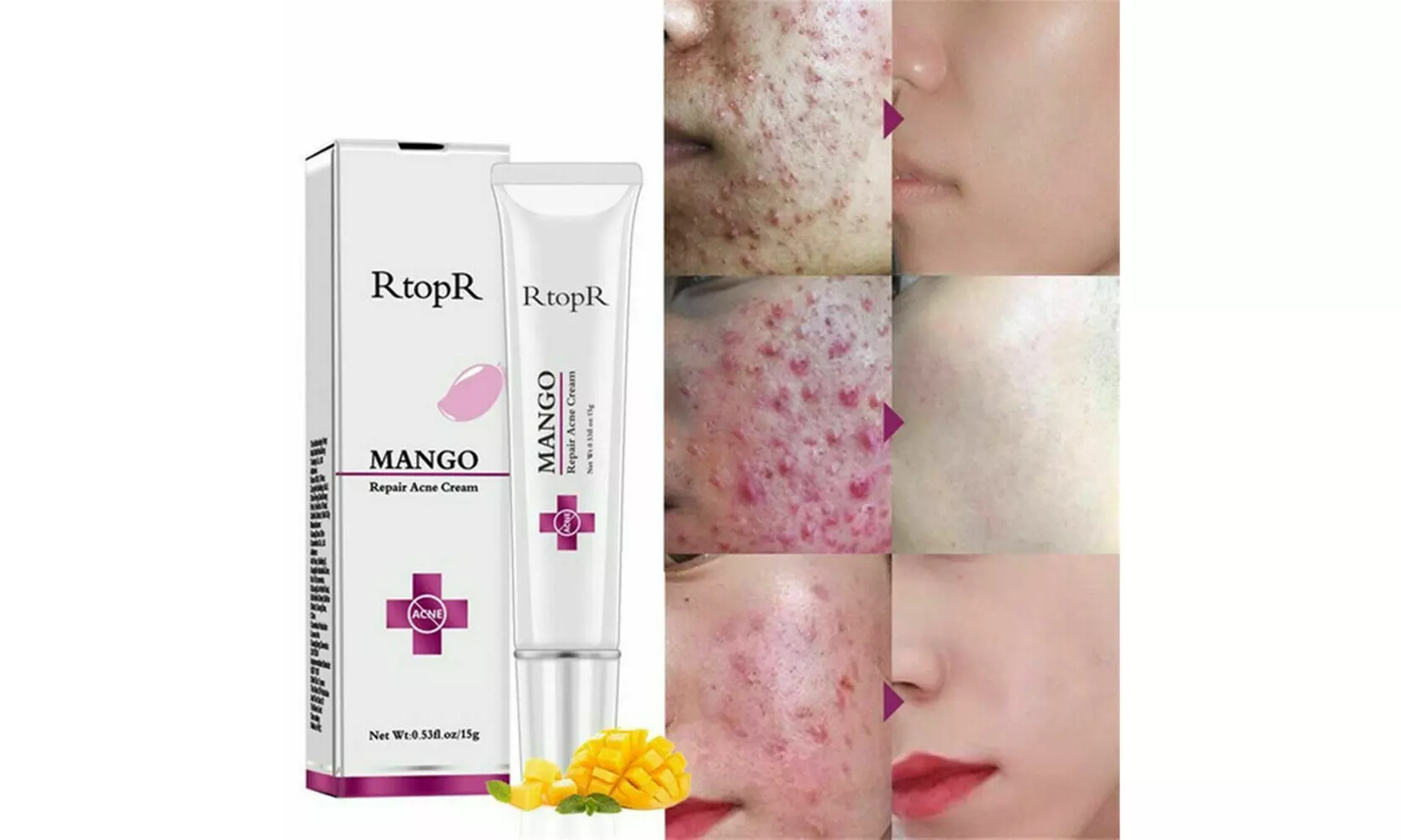 Rtopr Pimple Scar Acne Mark Spots Removal Treatment Gel Ointment Blemish Cream - Primary Image