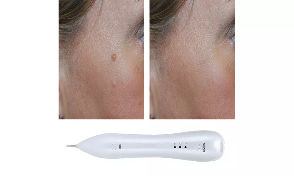 Rechargeable Skin Spot, Mole & Tattoo Remover Pen  - Primary Image